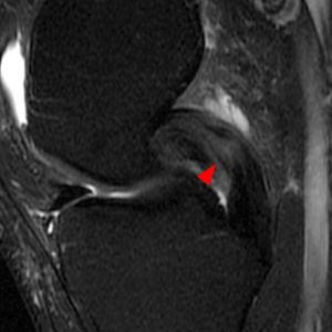 Medical image: MR images demonstrating a partial tear of the posterior cruciate ligament