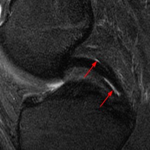 Medical image: 24 year-old professional rugby player with an acute partial tear of the posterior cruciate ligament with interstitial delamination