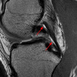 Medical image: 24 year-old professional rugby player with an acute partial tear of the posterior cruciate ligament with interstitial delamination