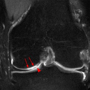 Medical image: Delamination of the articular cartilage of the medial femoral condyle (arrows) as displayed in a coronal fat-suppressed T2-weighted MR image