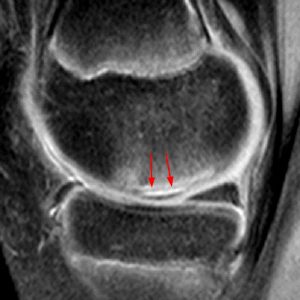 Medical image: 14 year-old basketball player with concealed delamination