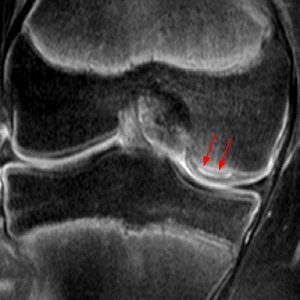 Medical image: 14 year-old basketball player with concealed delamination