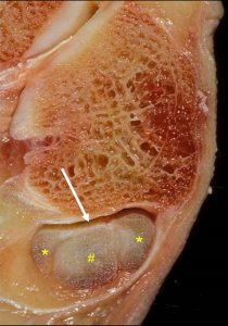 Medical image: Longitudinal split tear of the peroneus brevis tendon