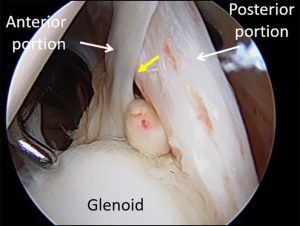 Medical image: Longitudinal split tearing of the intra-articular segment of the biceps tendon