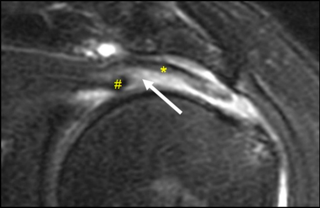 Medical images:Full-thickness delaminating supraspinatus tendon tear