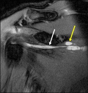 Medical images: Coronal T2-weighted fat-suppressed MR image and sagittal T2-weighted fat-suppressed MR image