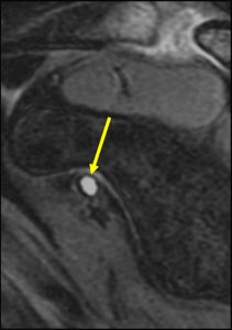 Medical images: Coronal T2-weighted fat-suppressed MR image and sagittal T2-weighted fat-suppressed MR image