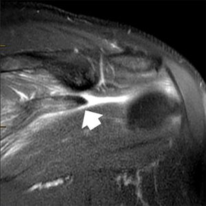 Medical images: Coronal and axial T2-weighted fat-suppressed MR images demonstrate a novel lesion of the infraspinatus tendon