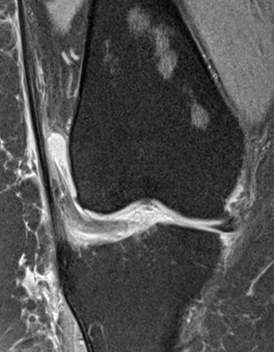Medical image - Red marrow reconversion in the knee