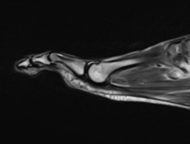 Medical image - bone marrow and subcutaneous tissues