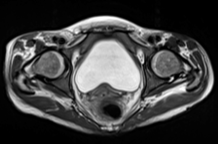 Medical image - bone marrow
