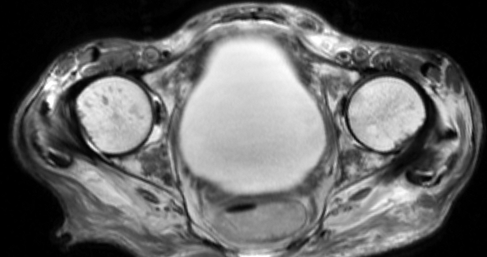 Medical image - serous atrophy of bone marrow