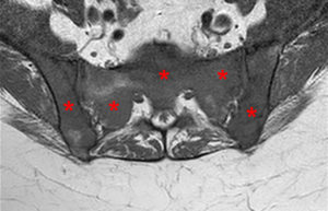 Medical image - sacrum and iliac bones