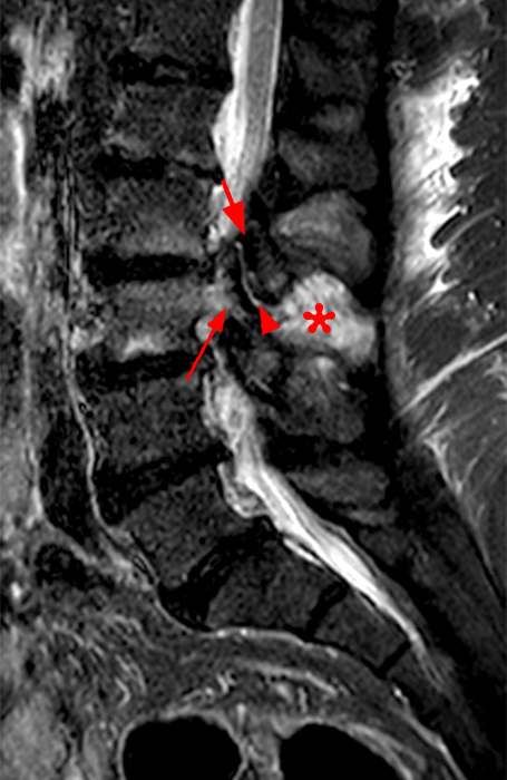 Medical image - lower lumbar