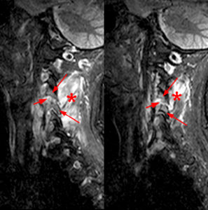 Left parasagittal and right parasagittal STIR images (Facet Synovitis)