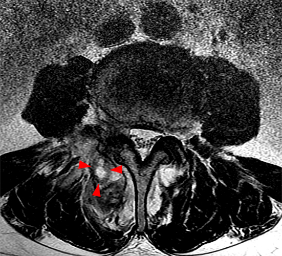 Medical image - low back (Facet Synovitis)