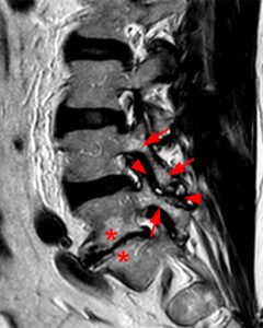 Medical image - low back (Facet Synovitis)
