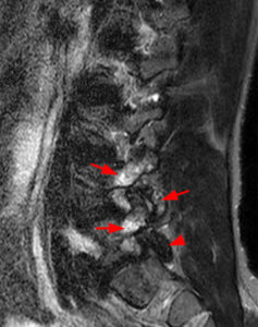 Medical image - STIR image (Facet Synovitis)