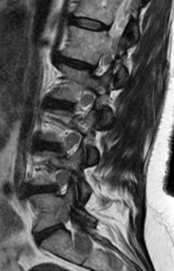 Parasagittal T2-weighted image (Radsource, MRI Web Clinic, Hypertrophic Peripheral Neuropathies)
