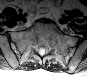 Axial T2-weighted image at the S1 level (Radsource, MRI Web Clinic, Hypertrophic Peripheral Neuropathies)