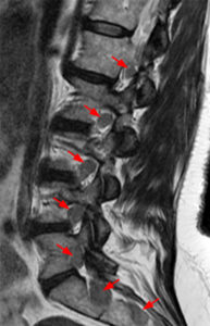 Parasagittal T2-weighted image demonstrates enlarged L1-5 and S1-2 nerve roots (Radsource, MRI Web Clinic, Hypertrophic Peripheral Neuropathies)