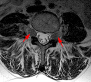 Enlarged bilateral L4 nerve roots are seen at the L4-5 level (Radsource, MRI Web Clinic, Hypertrophic Peripheral Neuropathies)