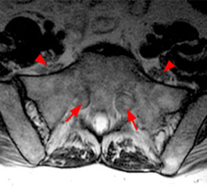 Enlarged bilateral S1 sacral nerve roots within the neural foramina (Radsource, MRI Web Clinic, Hypertrophic Peripheral Neuropathies)