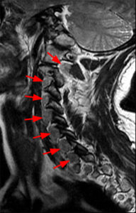 Parasagittal T2-weighted image of the cervical spine (Radsource, MRI Web Clinic, Hypertrophic Peripheral Neuropathies)