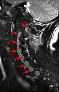 Parasagittal T2-weighted fat-suppressed image of the cervical spine (Radsource, MRI Web Clinic, Hypertrophic Peripheral Neuropathies)