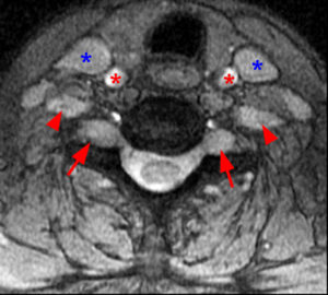 An axial 2D MERGE sequence at the C6-7 level demonstrates enlarged bilateral C7 nerve roots at the dorsal root ganglia and enlarged bilateral extraforaminal C6 nerve roots. The internal jugular veins and common carotid arteries are also seen at this level. (Radsource, MRI Web Clinic, Hypertrophic Peripheral Neuropathies)