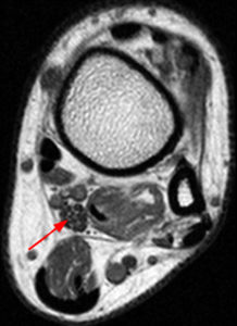 Axial T1-weighted image at the level of the distal tibia (proximal to the tarsal tunnel) demonstrates an abnormally enlarged tibial nerve (Radsource, MRI Web Clinic, Hypertrophic Peripheral Neuropathies)