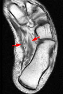 Axial T1-weighted image shows pes cavovarus deformity and atrophy of the medial musculature of the foot (Radsource, MRI Web Clinic, Hypertrophic Peripheral Neuropathies)