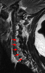 Parasagittal T2-weighted sequences through the cervical spine show thickened C5 through C8 and T1 nerve roots (Radsource, MRI Web Clinic, Hypertrophic Peripheral Neuropathies)