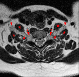 Axial T2-weighted image at C7-T1 demonstrates enlarged bilateral C8 roots at the level of the dorsal root ganglia and enlarged bilateral C7 brachial plexus nerves roots coursing between the anterior and middle scalene muscles (Radsource, MRI Web Clinic, Hypertrophic Peripheral Neuropathies)