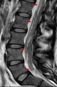 Parasagittal T2-weighted image (Radsource, MRI Web Clinic, Hypertrophic Peripheral Neuropathies)