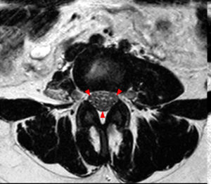 Axial T2-weighted images at the L3-4 level (Radsource, MRI Web Clinic, Hypertrophic Peripheral Neuropathies)