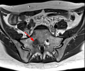 Axial T1-weighted image demonstrates an enlarged right S1 nerve root within the neural foramen (Radsource, MRI Web Clinic, Hypertrophic Peripheral Neuropathies)