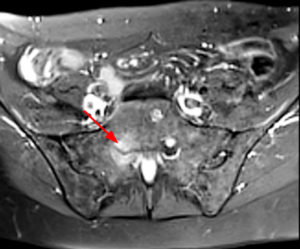 Axial T2-weighted image with fat-suppression demonstrates an enlarged right S1 nerve root within the neural foramen (Radsource, MRI Web Clinic, Hypertrophic Peripheral Neuropathies)