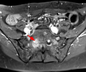 Axial T1-weighted post contrast image with fat-suppression shows associated nerve root enhancement (Radsource, MRI Web Clinic, Hypertrophic Peripheral Neuropathies)