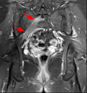 Coronal T1-weighted post contrast images with fat-suppression shows associated nerve root enhancement (Radsource, MRI Web Clinic, Hypertrophic Peripheral Neuropathies)