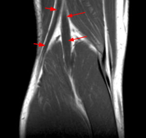 Coronal T1 and T2-weighted images of the posterior knee (Radsource, MRI Web Clinic, Hypertrophic Peripheral Neuropathies)