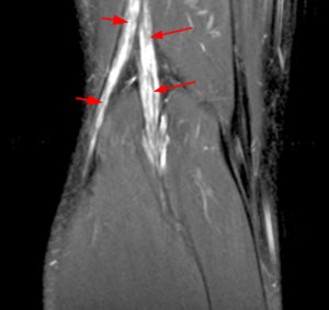Coronal T1 and T2-weighted images of the posterior knee (Radsource, MRI Web Clinic, Hypertrophic Peripheral Neuropathies)