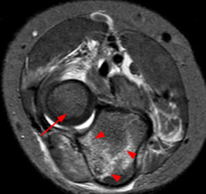 T2-weighted axial image