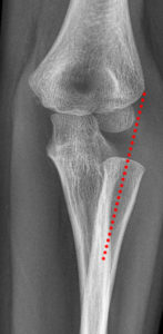 Frontal radiograph of the elbow