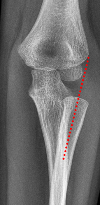 Frontal radiograph of the elbow