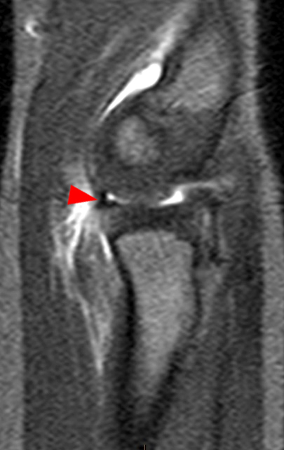 Fat-suppressed T2-weighted sagittal image
