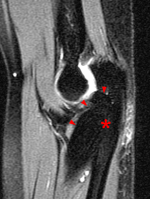 T2-weighted sagittal image