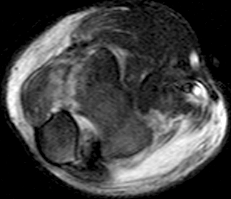 Fat-suppressed T2-weighted axial image