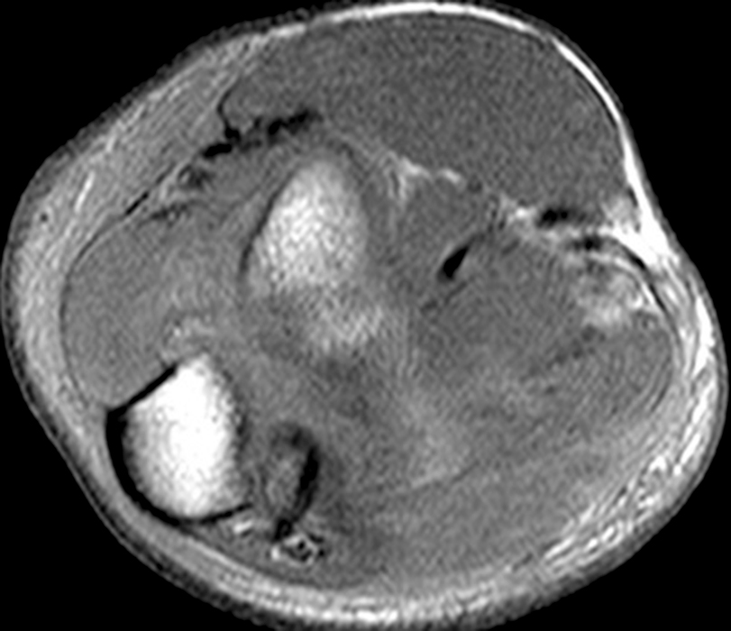 Fat-suppressed T1-weighted axial image