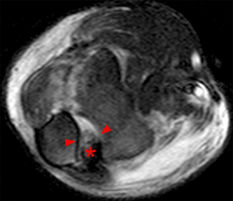 Axial fat-suppressed T2-weighted image